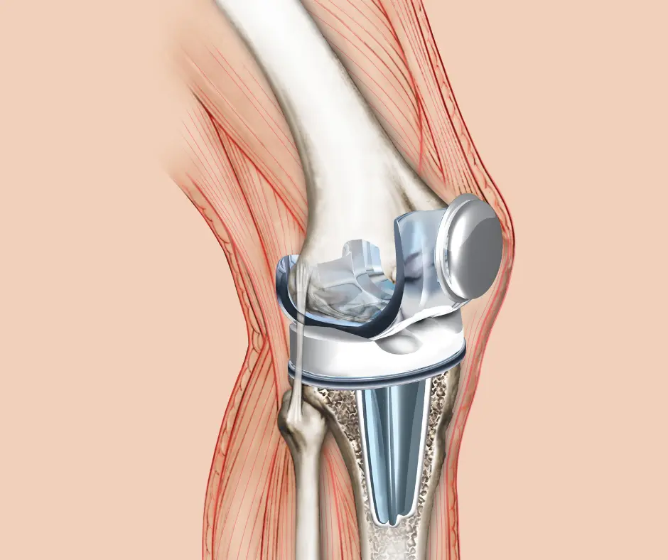 Revision Joint Replacement Surgery
