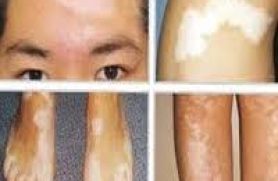 LEUCODERMA CLINIC LEUCODERMA CLINIC